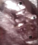 妊娠4ヶ月(妊娠13週)超音波写真