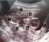 妊娠4ヶ月(妊娠13週)超音波写真